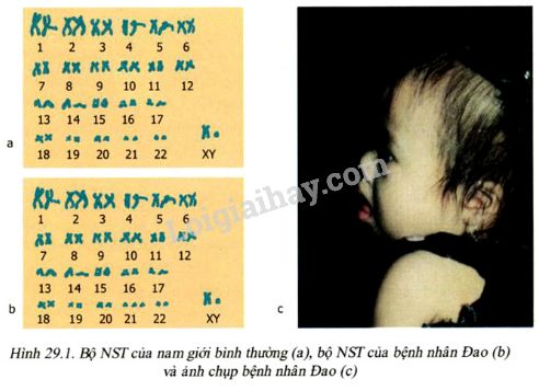 Điểm khác nhau giữa bộ nst của bệnh nhân Đao